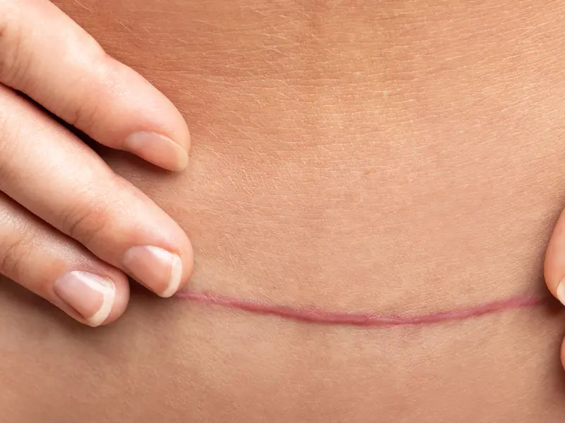 Césarienne programmée