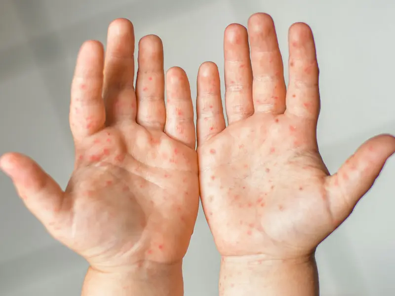 Maladie pieds main bouche